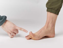 Running with Flat Feet vs High Arches 